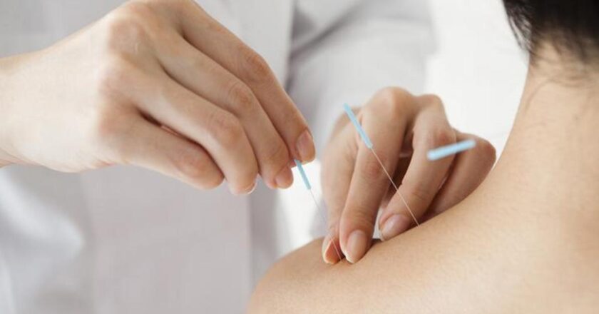 Akupunktur nedir, ne yapar? Akupunktur tedavisi hangi durumlarda uygulanır?