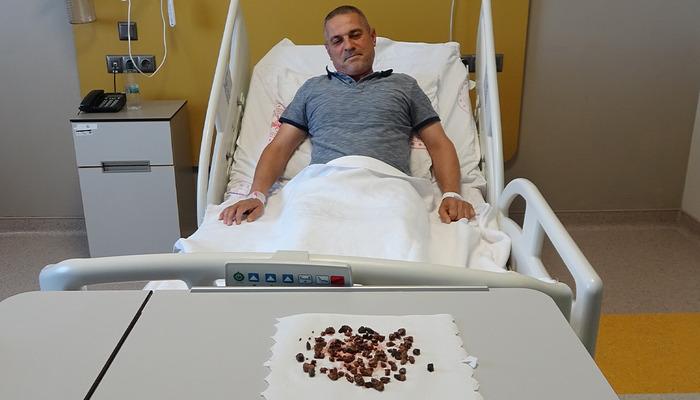 Doktorları şaşırtan durum: adamın böbreğinden neredeyse 100 taş çıktı: “Tüm sağ böbrek taşlarla doluydu”